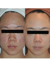 ホワイトアクア 姫路店(WHITE AQUA)/ララピール/姫路/美白