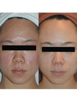 ホワイトアクア 姫路店(WHITE AQUA)/ララピール/姫路/美白