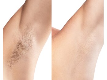 ラナ(LANA)/脇脱毛/BeforeAfter