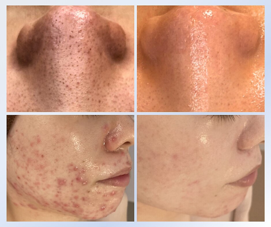 【毛穴洗浄】 エヌエースキン 横浜店(NAskin)｜ホットペッパービューティー