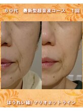 ナイア(naia)/最新型超音波コース