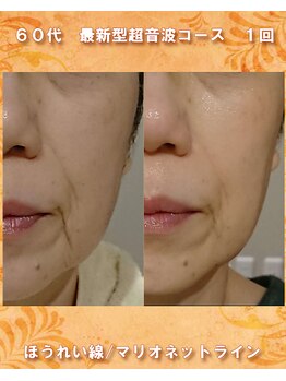 ナイア(naia)/最新型超音波コース