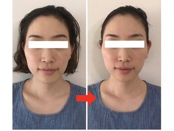 小顔矯正サロン セラフィ/1回目で輪郭すっきりバランス◎