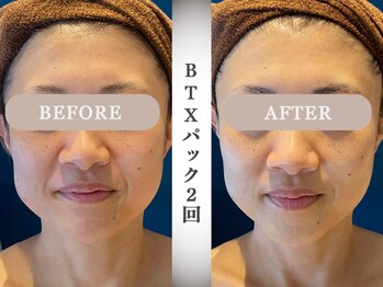 モルティー 宇都宮東店(Molti)/たるみ/引き締め/小顔矯正/BTX