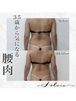 ソルヴィス(SOLVIS)/