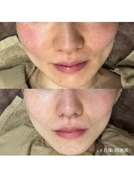 ダリア(Dahlia)の写真/【話題のプラズマシャワー】ダウンタイムなしの毛穴ケアで肌改善☆お肌の汚れを殺菌＆保湿効果◎