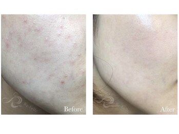 エクセレントビューティーサロン 艶(EN)/リベルハーブピーリング