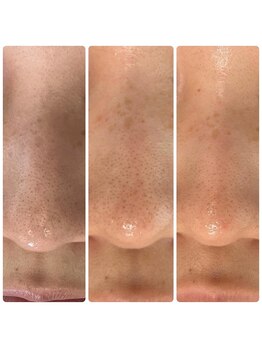 レディースシェービングサロン アール(R)/毛穴の黒ずみお悩みの方