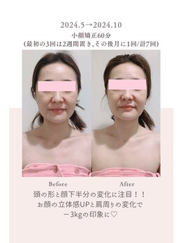 トゥインクル 麻布(twinkle)/南麻布/シンメトリー小顔矯正