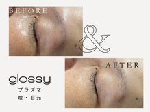 グロッシー(glossy)/【症例】目元・瞼のタルミ50代