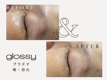 グロッシー(glossy)/【症例】目元・瞼のタルミ50代