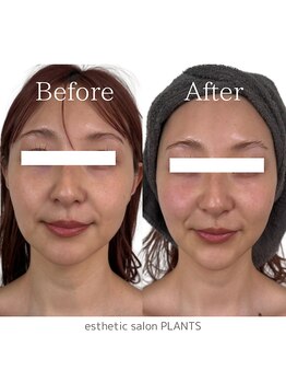 プランツ(PLANTS)/30代／１回／小顔・リフトアップ