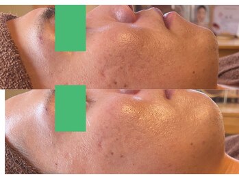 ルアーナ(Luana)/ニキビ悩み