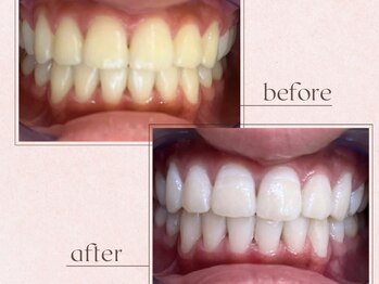 ルアナシンフォニア エクシア 東銀座店(Luana-Sinfonia)/ホワイトニングビフォーアフター