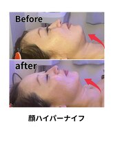 ビービー(BB)/ハイパーナイフ顔＋かっさ