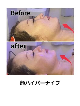 ビービー(BB)/ハイパーナイフ顔＋かっさ