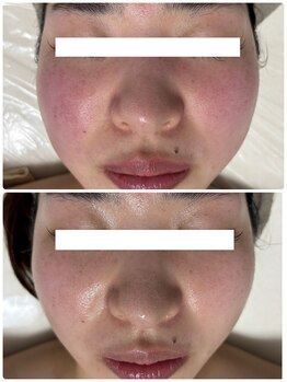 リクラ 北千住(Reclat)/1回のビフォーアフター