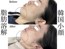 リベルキョウト 京都駅前店(Liber Kyoto)の雰囲気（二重顎撃退!!脂肪分解導入★ダウンタイムなし!ブライダル前も◎）