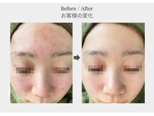 ベル 新橋(Belle)/ハーブピーリング×ニキビ乾燥