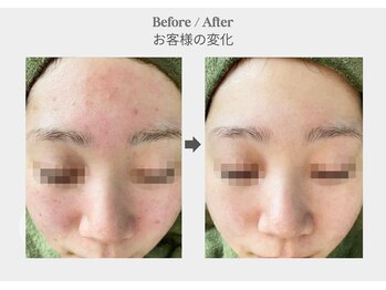 ベル 新橋(Belle)/ハーブピーリング×ニキビ乾燥