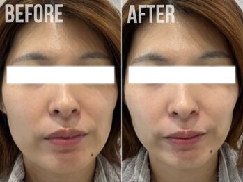 煌(kirameki)/【小顔】小顔リフトUP症例