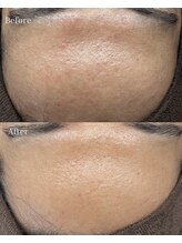 ベリスユイット(BELLIS HUIT)/【剥離ありハーブピーリング】