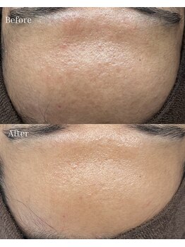 ベリスユイット(BELLIS HUIT)/【剥離ありハーブピーリング】