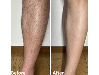 リンカ(Rinca)/メンズ脱毛　（足）