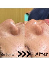 ゆしんアネックス/全顔毛穴洗浄ビフォーアフター☆