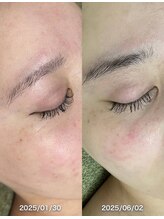 サロンドジェシカ(salon de Jessica)/プラズマフェイシャル