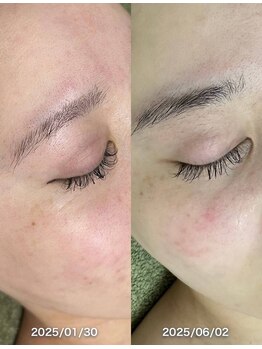 サロンドジェシカ(salon de Jessica)/プラズマフェイシャル