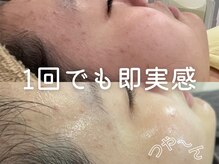 サロンラジュローズ(Salon La joue Rose)の雰囲気（REVIハーブピーリング×ヒト幹細胞導入　肌荒れニキビケア、毛穴）