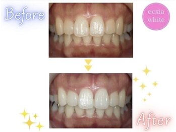 エクシアホワイトニング 静岡駅前店/ホワイトニングビフォーアフター