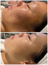 リノセス(Linocess)/ニキビ改善