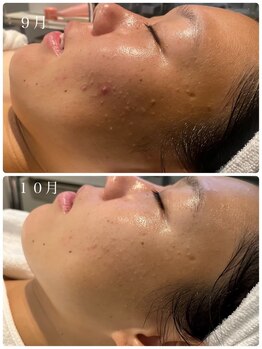 リノセス(Linocess)/ニキビ改善