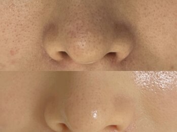 エース(ace)/艶肌爆誕セラピール