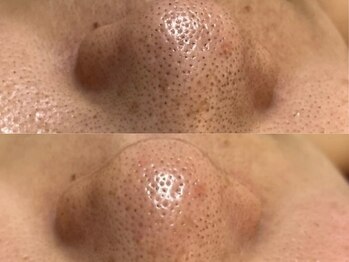 GRACETHOUSAND(グレイスサウザンド)/ハイドラ毛穴洗浄/毛穴の黒ずみ