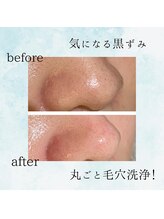 ミュー(professional beauty salon MYU)/【毛穴ケア】ハイドロ毛穴洗浄