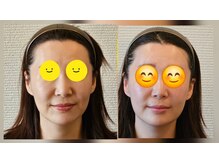 金梨花サロン/法令線→マリオネットライン改善