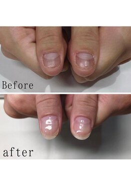 ティアラネイル 宇都宮/深爪矯正