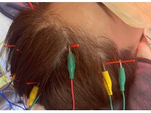 美容頭鍼！頭からたるみを引き上げる！頭痛や眼精疲労にも◎