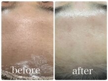 エクラニーク(Eclanique)/シュガーリング脱毛お顔☆