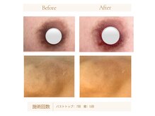 ナナイロ 下郡店(nanairo)の雰囲気（韓国発☆メラニンケア。夏に向けてやるなら今！！）
