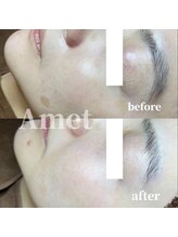 アメット(Amet)/シミケア