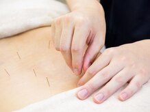 鍼灸整骨院ちとせ/鍼灸施術