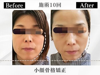 ポーベルポー(Peau Belle poe)/基本の小顔骨格矯正 10回目