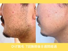 エクレ 柏店(EKURE)/EKURE柏で人気のヒゲ脱毛