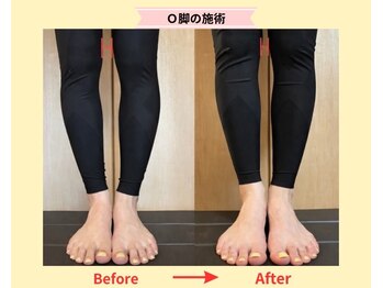 アイノテ メディカルボディケア(Ainote medical body care)/[O脚の施術例紹介]