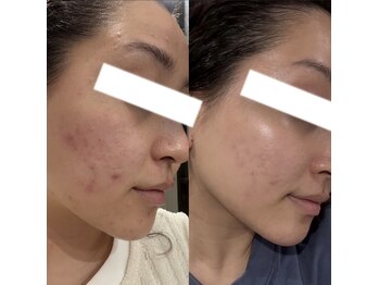 サロン アイプラス(salon i plus)の写真/完全個室の贅沢空間でお肌を徹底的にきれいに。美意識の高い結果にこだわる大人女性のための集中肌質改善◎