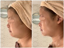 スペチアーレ 夙川/【顔ハイリフ無制限】エステ越え